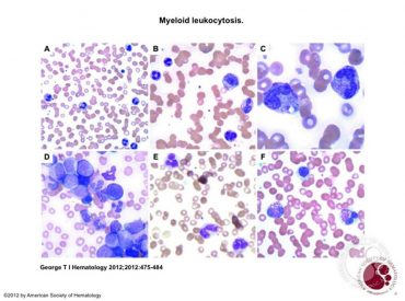 leucocitosis